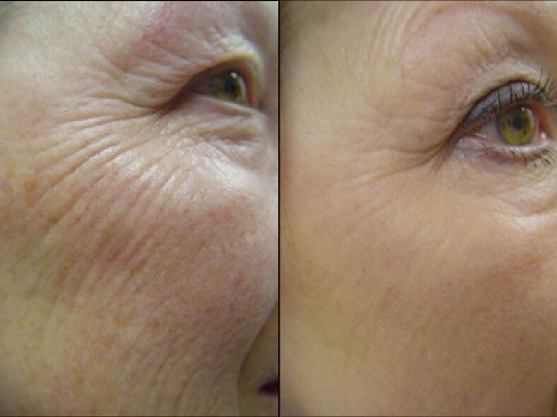 Before and after laser resurfacing treatment – ​​significant reduction of wrinkles