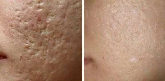 Laser grinding of scars