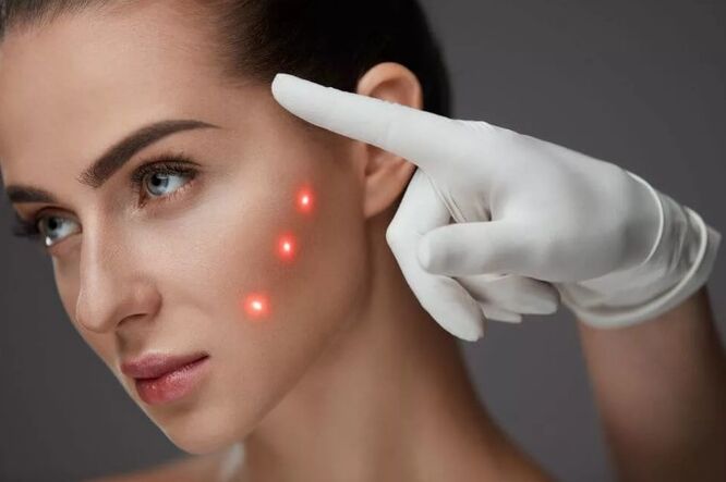 Laser rejuvenation of the skin
