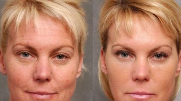 Before and after the rejuvenation procedure
